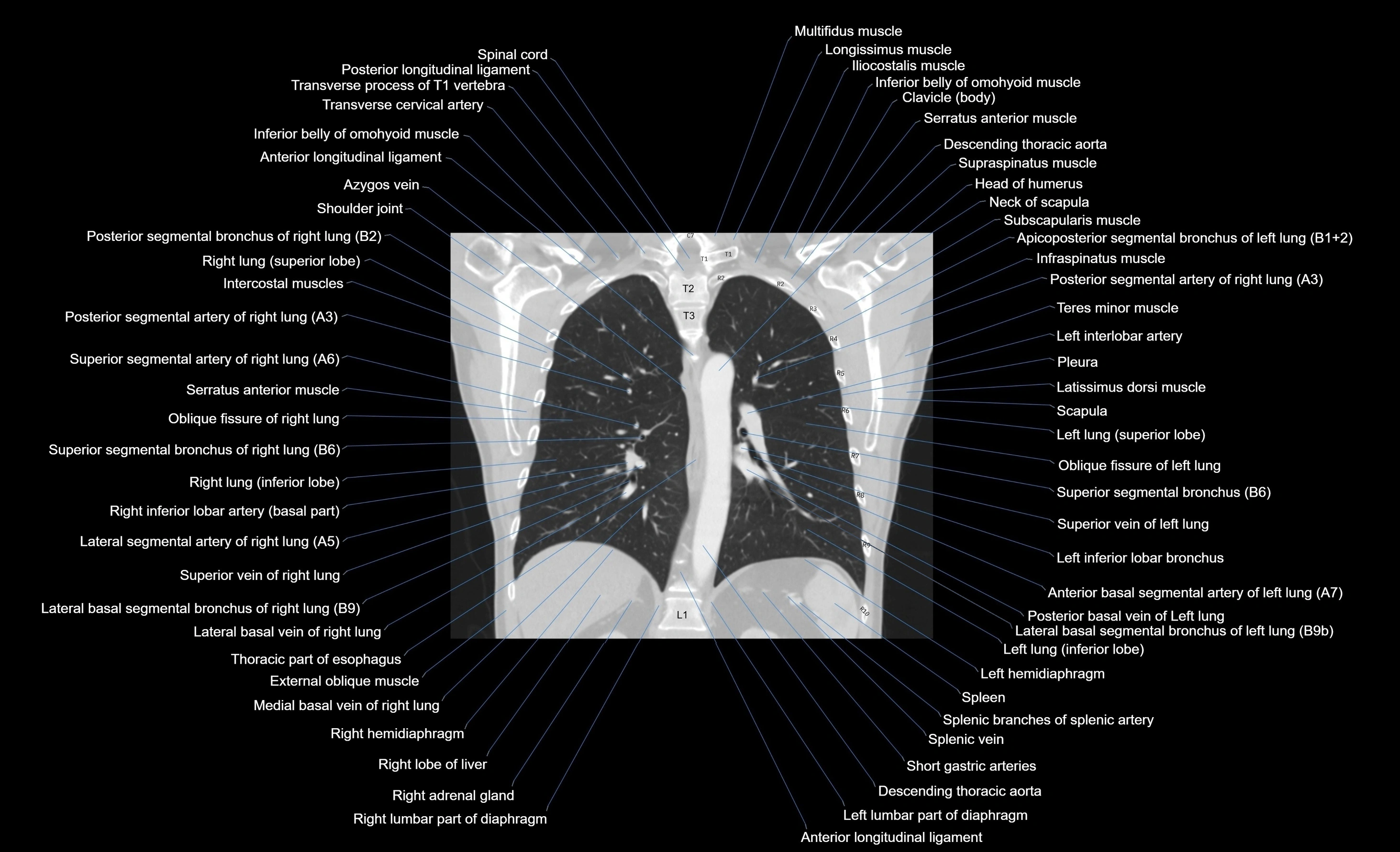 CT chest (thorax) lung window window labelled coronal cross sectional anatomy radiology image-00048.webp